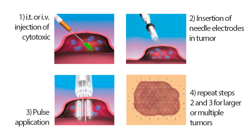 Tech Electrochemotherapy